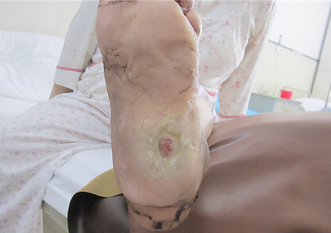 骨髓炎脚趾坏死,脚部骨髓炎的症状和治疗