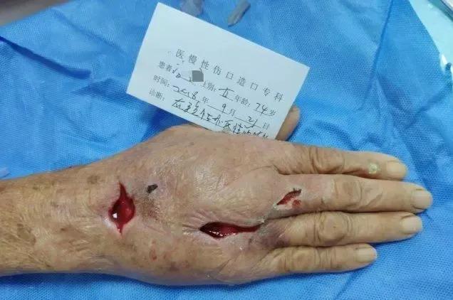 挤痘痘可引起败血症吗,挤痘痘引发的颅内感染能自己好吗