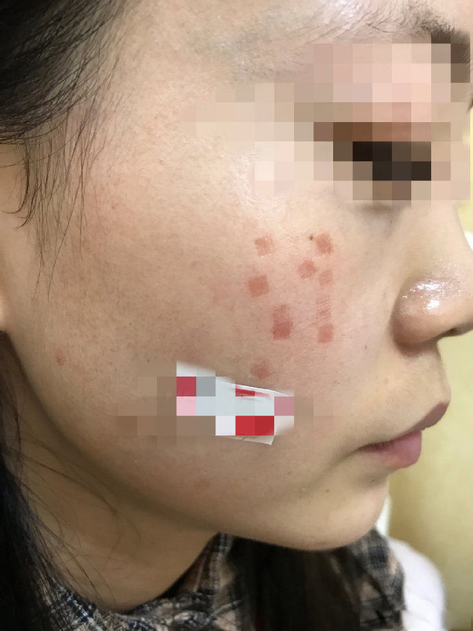 点阵激光能把伤疤完全修复吗,激光点阵可以修复到多少程度