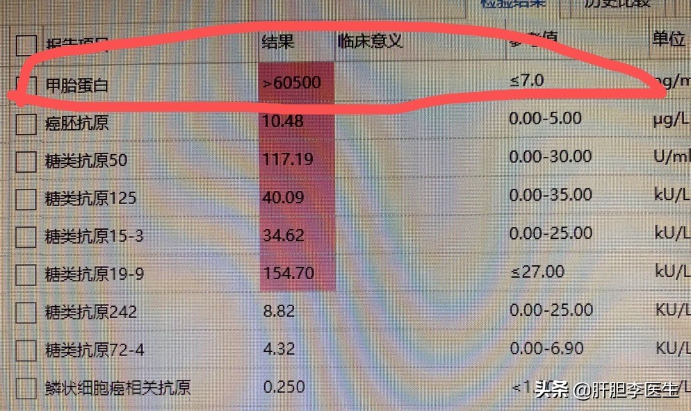 肝癌晚期的症状表现能活多久,肝癌晚期的6个表现腹部疼痛
