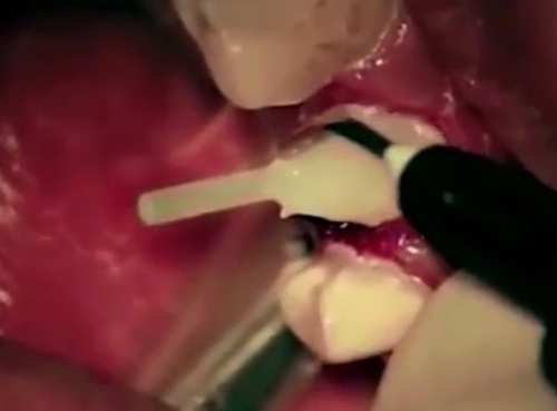 补牙有哪些流程,补牙以后需要注意什么