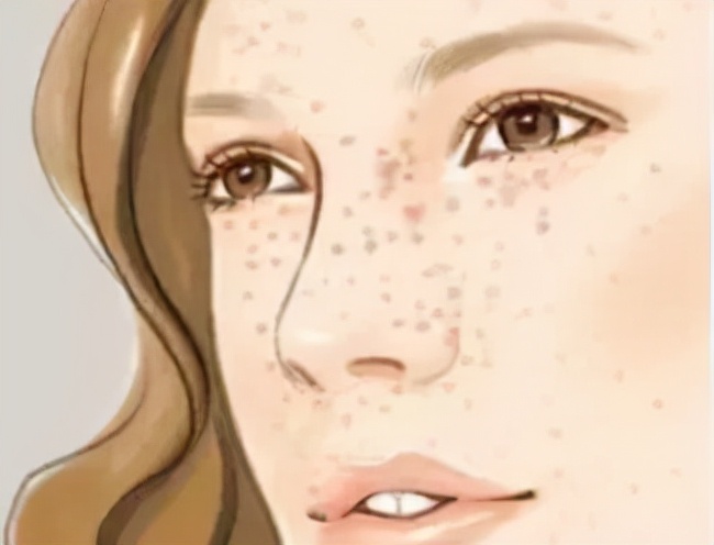 色斑有几种如何去区分,色斑在医院挂什么科