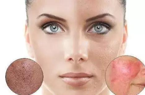 痘印祛痘药膏,痘印去除护肤品