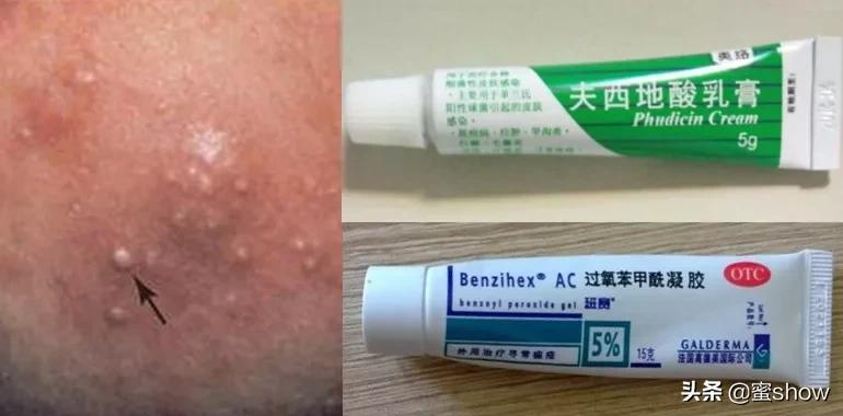 皮肤问题控油缓解长痘,解决皮肤痘痘问题