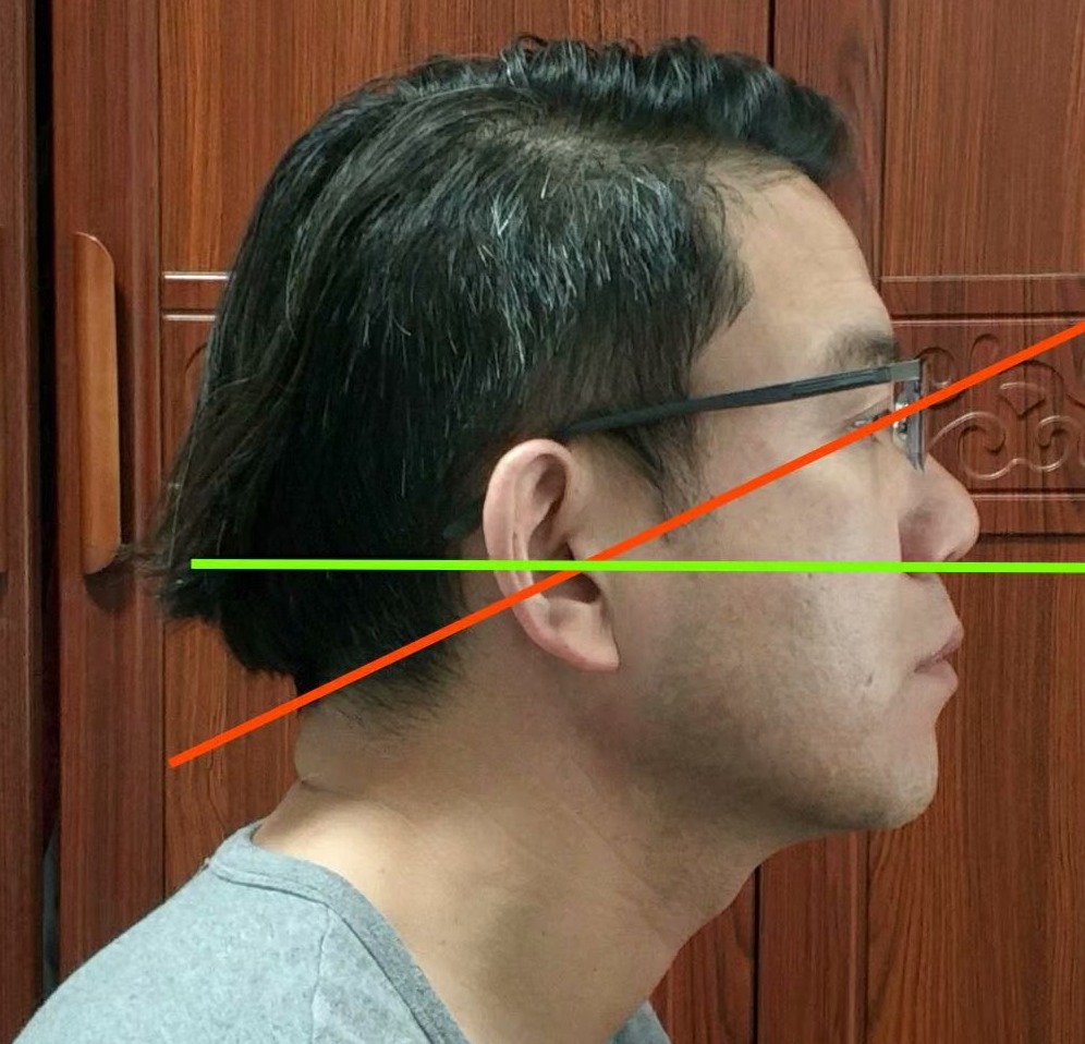脖子后面颈椎有个鼓包怎么办,颈椎大包怎样通过锻炼来恢复