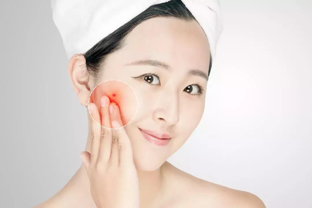 激素脸的特征和症状,激素脸形成的特征