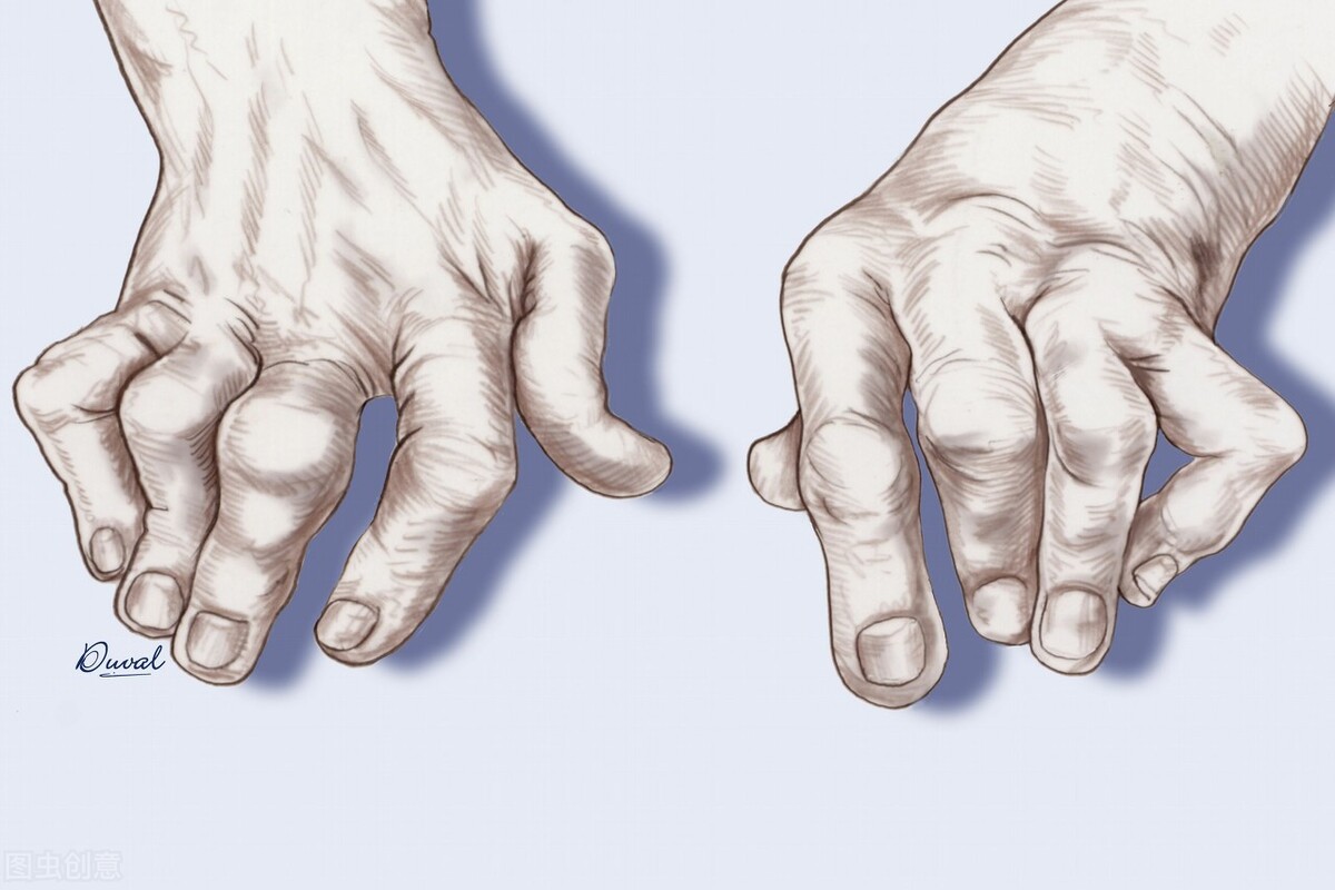 痛风急性发作期中医处理办法,痛风临床诊断治疗与建议