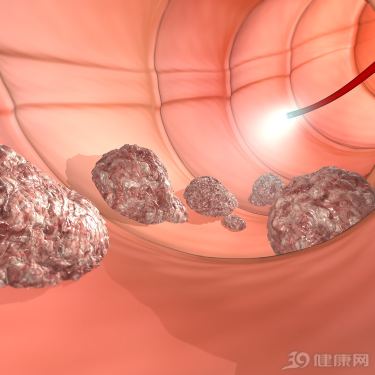 肠镜检查怎么做可以减少痛苦,做肠镜检查怎么知道要做什么