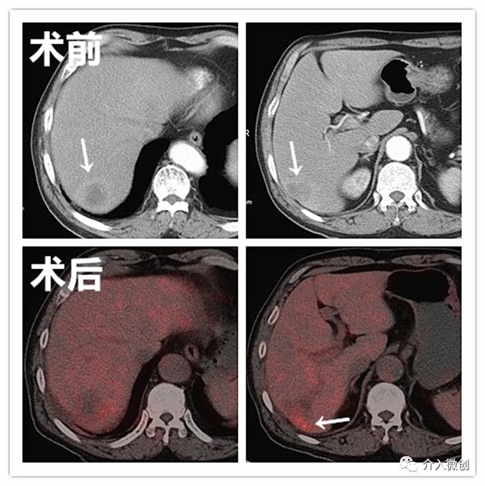 栓塞介入能治疗肝转移瘤吗,结肠癌肝转移介入栓塞治疗