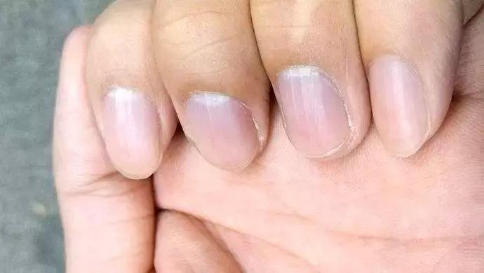 大拇指指甲有竖纹跟凹陷怎么回事,大拇指甲上有白色竖纹是怎么回事