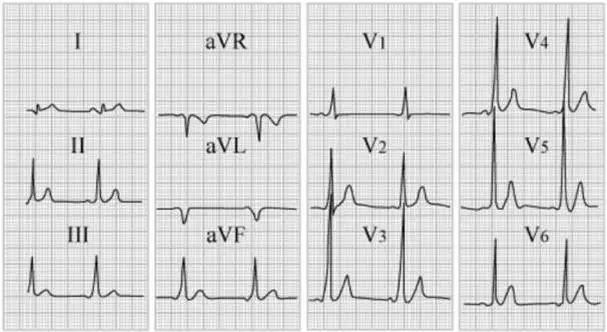 心律失常55分钟讲解,心律失常心电图讲解视频教程全集