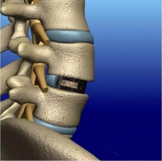 腰椎间盘突出针灸有副作用吗,腰椎间盘突出针灸越来越严重