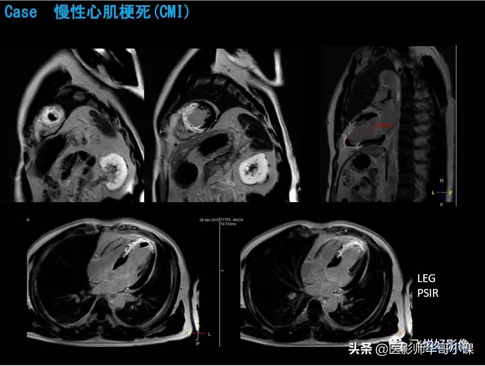飞利浦核磁共振快速扫描,飞利浦磁共振心脏扫描