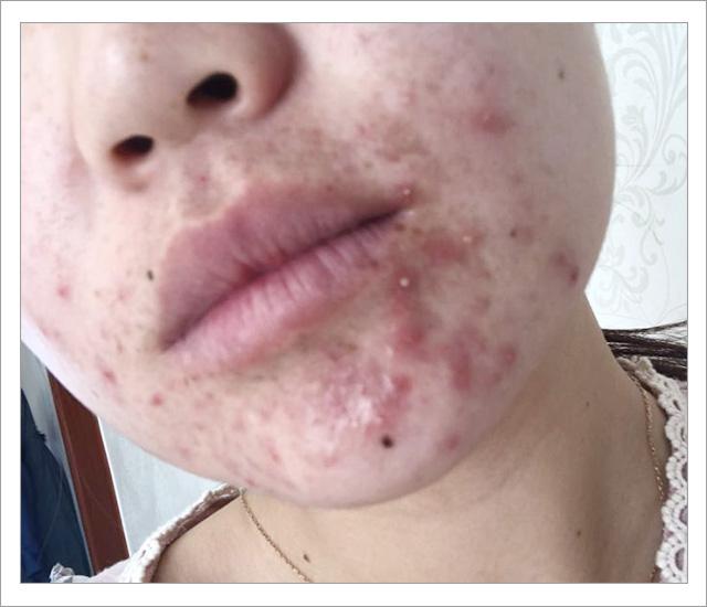 脸上螨虫的正确消灭方法,脸上的螨虫能不能彻底消灭