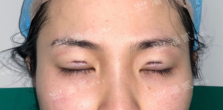 割了开扇双眼皮眼尾上扬太宽,眼尾上扬的眼睛适合什么双眼皮