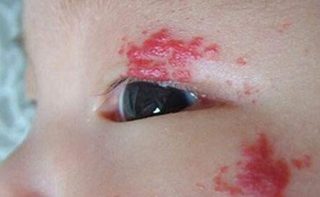 郴州市第一人民医院祛胎记,郴州第一人民医院治疗肝脏血管瘤