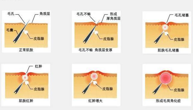 果酸精华改善鸡皮肤,医院果酸换肤鸡皮肤能用吗