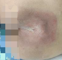 深度褥疮的有效治疗药,一期压疮康复进展