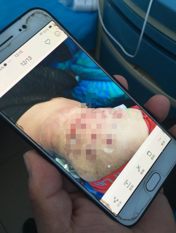 针灸感染,河南诊所针灸感染