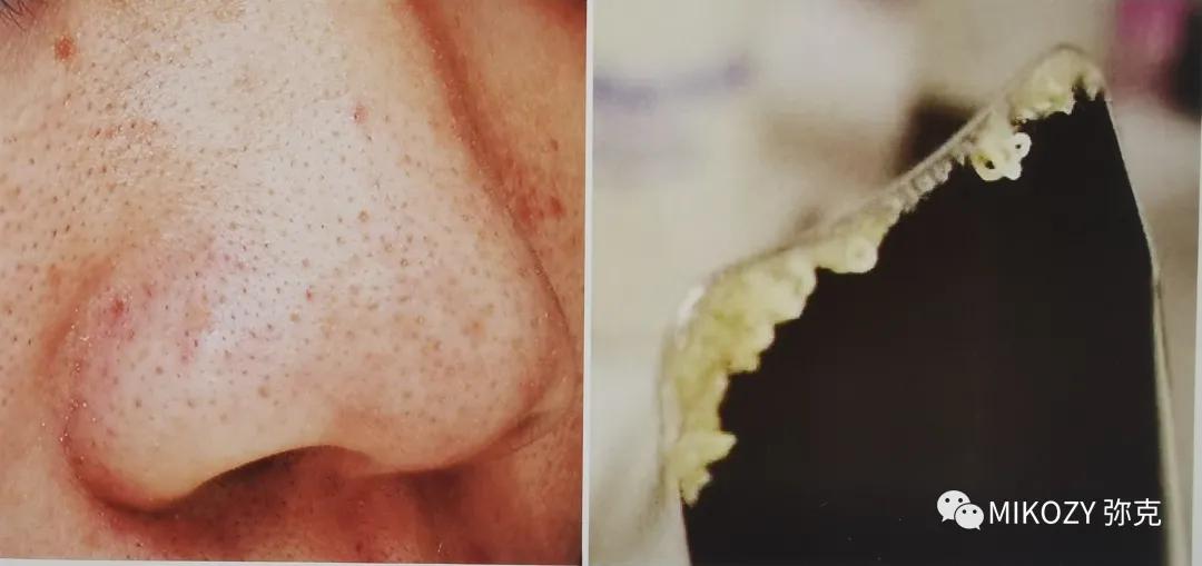 去除陈年深黑头,清理黑头哪家强