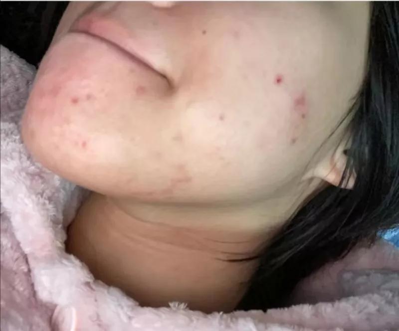 戴口罩脸上痘痘怎么快速消除,戴口罩长痘如何正确护理