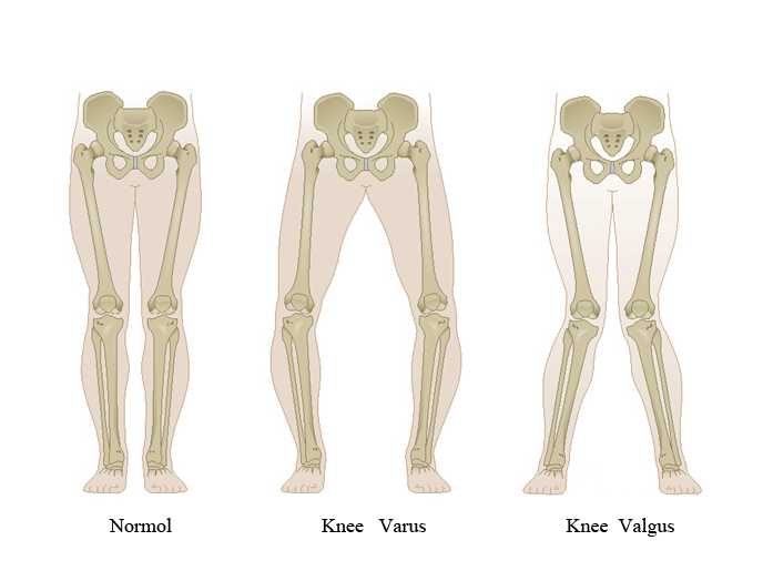 深蹲膝盖不超过脚尖就向后倒,深蹲可以改善膝盖内扣吗