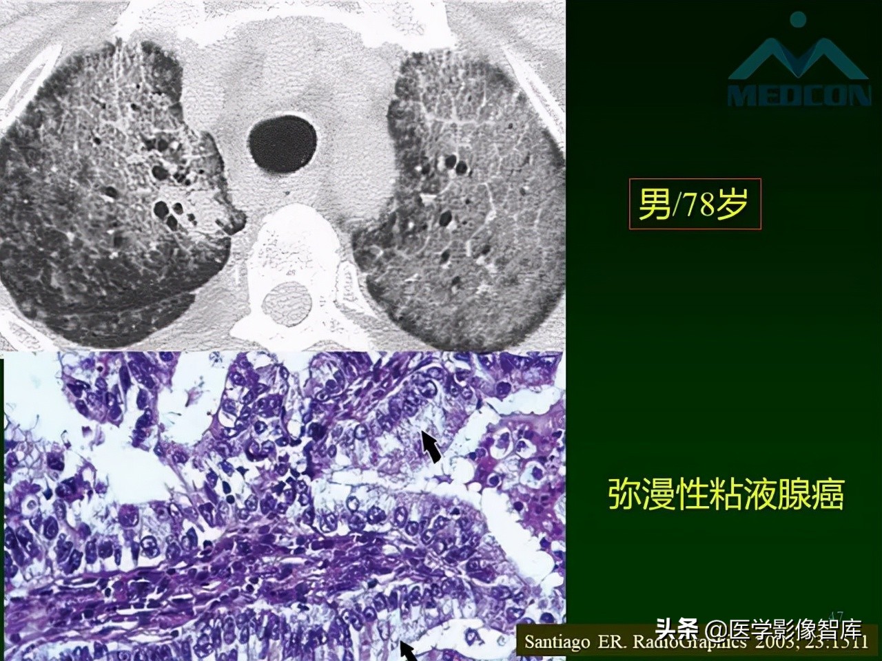 肺弥漫性网状影,两肺小叶间隔增厚可见网状模糊影