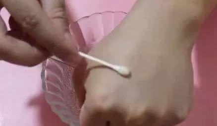 脸上涂红霉素软膏能让皮肤白吗,红霉素软膏能去除脸上的小红点