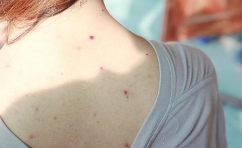 背部毛孔大长痘,背部毛孔粗大有黑毛