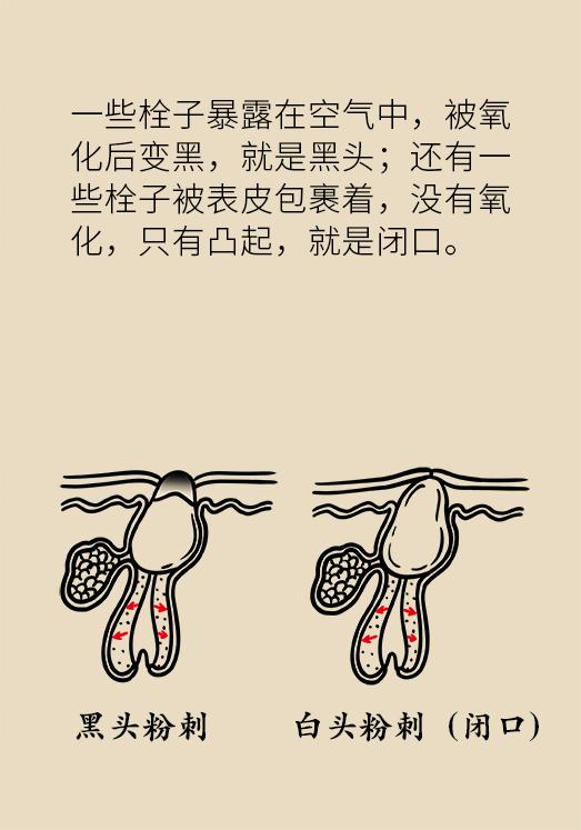 协和医院教你祛痘,长痘别着急中医祛痘秘方来帮你