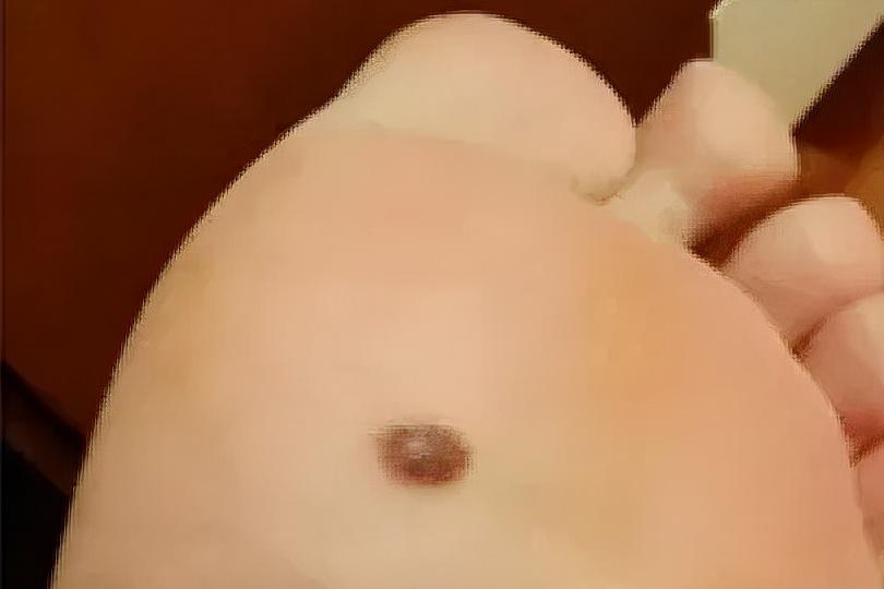 一般凸起的黑痣会癌变吗,长了20多年的黑痣有可能会癌变吗