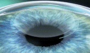 飞秒激光近视手术有什么副作用,矫正近视手术有什么副作用