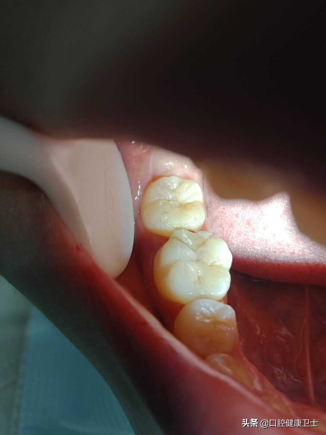 补牙后的牙缝越来越大怎么办,补牙之后牙缝塞东西导致牙龈痛