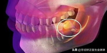 智齿疼吃什么药能快速缓解,智齿疼吃什么止疼药见效快