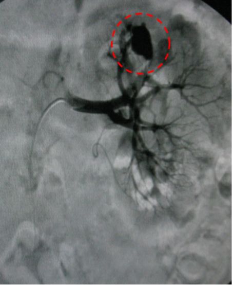 举例科普|介入能治疗哪些疾病?