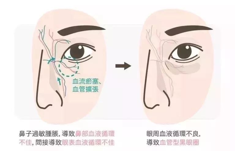 没有熬夜却有黑眼圈怎么消除,没熬夜的黑眼圈怎么去除