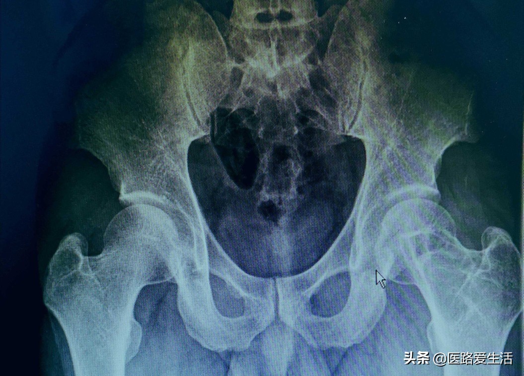 骨肿瘤能彻底治愈吗,骨肿瘤良性和恶性影像区别