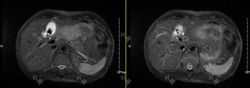 小胆囊也能造成大危害——高龄胆囊癌患者的治疗经历