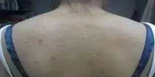 背后长粉刺痘痘是怎么回事,青春期孩子背后长痘是什么原因