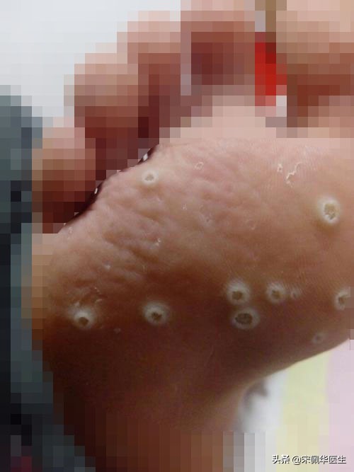 如何区分跖疣和鸡眼,怎么分辨跖疣和鸡眼