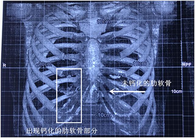 鼻整形案例分享注射隆鼻术,朝天鼻耳软骨假体隆鼻过程