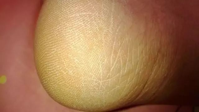 手脚干裂皮肤又厚又痒怎么办,冬天手脚干裂起皮怎么治疗