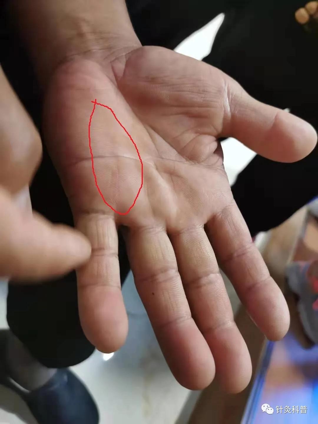 民间中医针灸治疗疑难杂症,中医疑难杂症针灸治疗成功