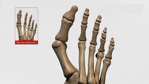 大脚骨是骨质增生吗,大脚骨是什么脚型