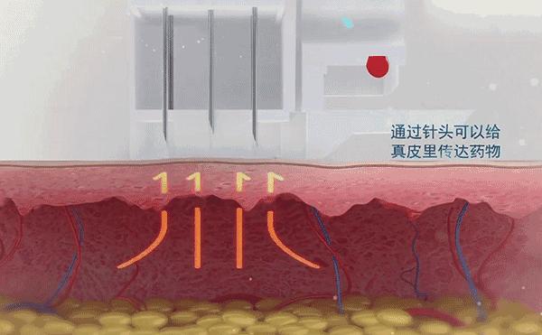 测评｜天天敷面膜和1个月打1次水光针，哪个效果好？