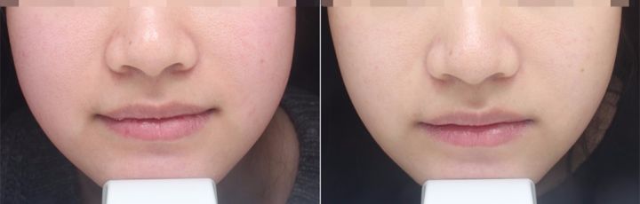 皮肤换季过敏干燥和痒护肤品,过敏干燥的脸部用哪种护肤品