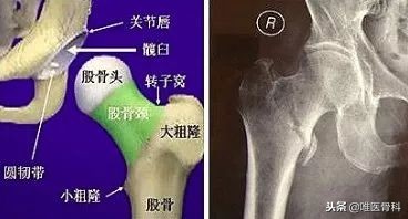 老年人的最后一次骨折,老年人请谨防人生最后一次骨折