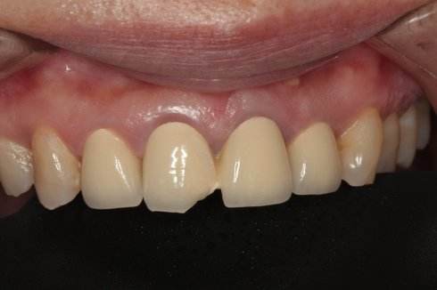 做了烤瓷牙之后牙根部变黑怎么办,做了烤瓷牙牙根黑的怎么办