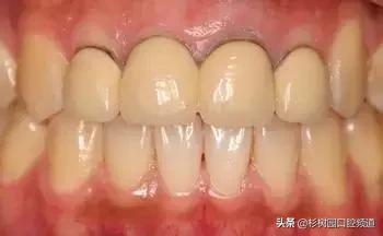 氧化锆全瓷牙价格表,氧化锆全瓷牙和全瓷冠