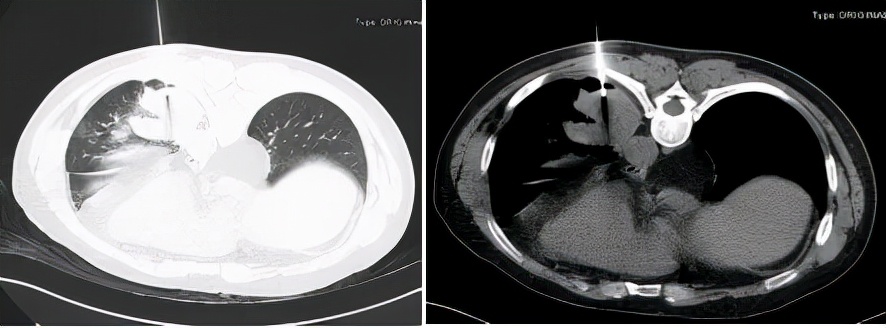 咳嗽10多天了有白痰细菌感染,咳嗽是肺部真菌感染吗